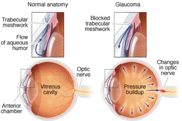 Glaucoma Detection